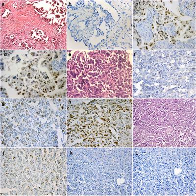 Diagnostic Utility of BAP1, EZH2 and Survivin in Differentiating Pleural Epithelioid Mesothelioma and Reactive Mesothelial Hyperplasia: Immunohistochemical Study